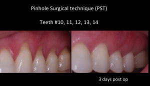 chao pinhole surgical technique